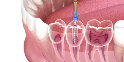 endodonzia-e-terapia-endodontica